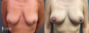 VPSI Before & After Mastopexy Patient 2c