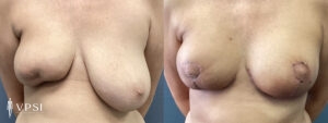 Vegas Breast Reconstruction Before & After Patient 2a