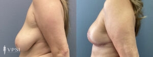 Vegas Breast Reconstruction Before & After Patient 2b