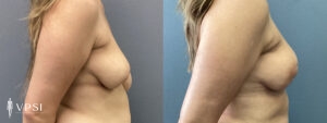 Vegas Breast Reconstruction Before & After Patient 2c
