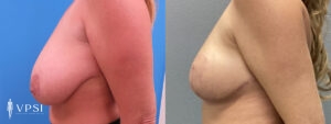 VPSI Before & Afters Breast Reduction Patient 1_b