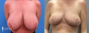 VPSI Before & Afters Breast Reduction Patient 1_c