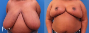 VPSI Before & Afters Breast Reduction Patient 2_c