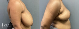 VPSI Before & Afters Breast Reduction Patient 3_a