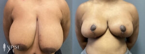 VPSI Before & Afters Breast Reduction Patient 3_c