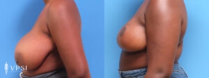 VPSI Before & Afters Breast Reduction Patient 4_b