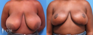VPSI Before & Afters Breast Reduction Patient 4_c