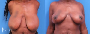 VPSI Before & Afters Breast Reduction Patient 5_c