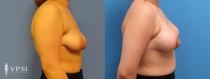 VPSI Before & Afters Tuberous Breast Patient 1a