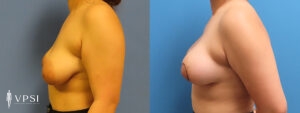 VPSI Before & Afters Tuberous Breast Patient 1b