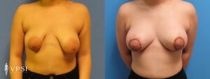 VPSI Before & Afters Tuberous Breast Patient 1c