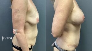 VPSI Before & Afters Mommy Makeover Patient 1a