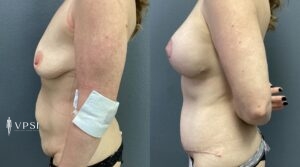 VPSI Before & Afters Mommy Makeover Patient 1b