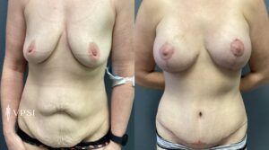 VPSI Before & Afters Mommy Makeover Patient 1c