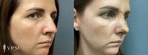VPSI Before & Afters Rhinoplasty Patient 1a