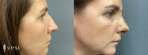VPSI Before & Afters Rhinoplasty Patient 1b
