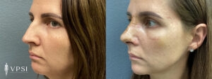 VPSI Before & Afters Rhinoplasty Patient 1c