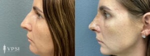 VPSI Before & Afters Rhinoplasty Patient 1d