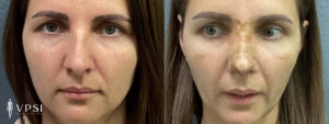 VPSI Before & Afters Rhinoplasty Patient 1e