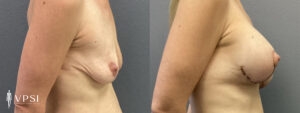 Vegas Mastopexy Before & After Patient 3a
