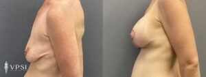 Vegas Mastopexy Before & After Patient 3b