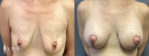 Vegas Mastopexy Before & After Patient 3c
