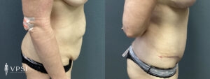 Vegas Before & After Tummy Tuck Patient 5a