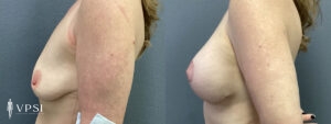 Vegas Before & After Breast Augmentation Patient 4b-1
