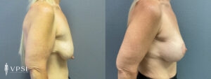 Vegas Breast Augmentation Before and After Patient 10a