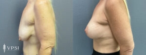 Vegas Breast Augmentation Before and After Patient 10b
