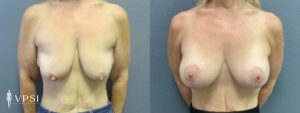 Vegas Breast Augmentation Before and After Patient 10c
